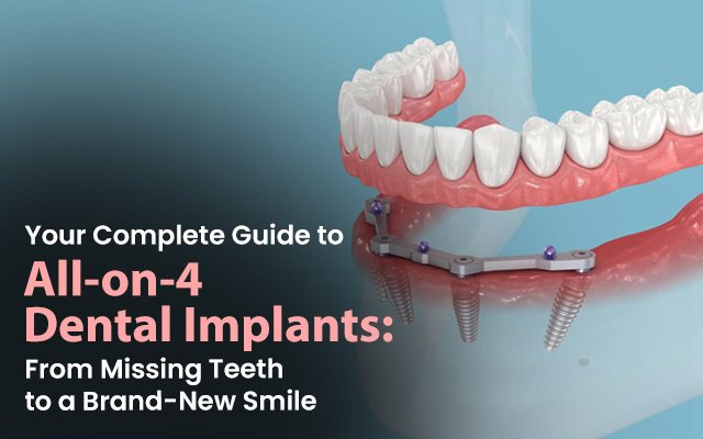 all on 4 dental implants in Kolkata