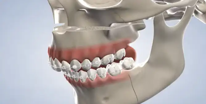 Benefits of Using Braces for Tooth Replacement