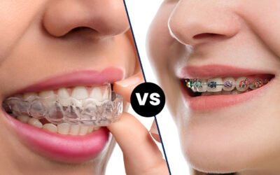 𝐈𝐧𝐯𝐢𝐬𝐚𝐥𝐢𝐠𝐧 𝐯𝐬 𝐓𝐫𝐚𝐝𝐢𝐭𝐢𝐨𝐧𝐚𝐥 𝐁𝐫𝐚𝐜𝐞𝐬: 𝐖𝐡𝐢𝐜𝐡 𝐈𝐬 𝐁𝐞𝐭𝐭𝐞𝐫 𝐟𝐨𝐫 𝐊𝐨𝐥𝐤𝐚𝐭𝐚’𝐬 𝐅𝐨𝐨𝐝𝐢𝐞 𝐋𝐢𝐟𝐞𝐬𝐭𝐲𝐥𝐞