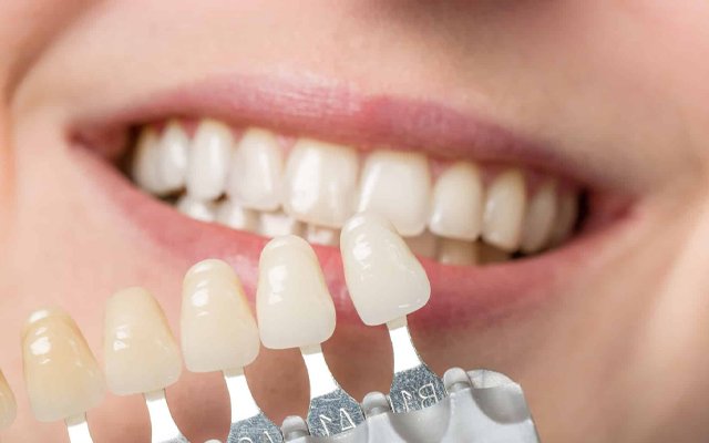 teeth whitening