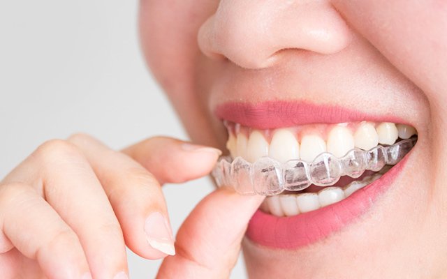 invisible dental braces in Kolkata