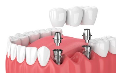What Causes Tooth Loss? 10 Reasons Dentists Commonly See 