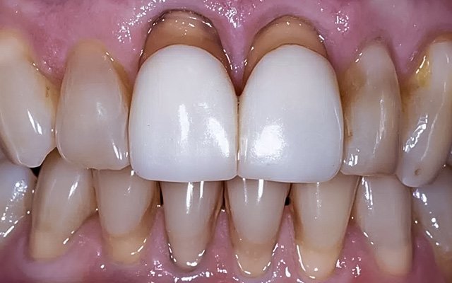 Receding Gums? Here's What Causes It and How to Stop It From Progressing